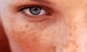 Cuide das Manchas na Pele