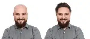 Ervas Naturais Contra Calvície