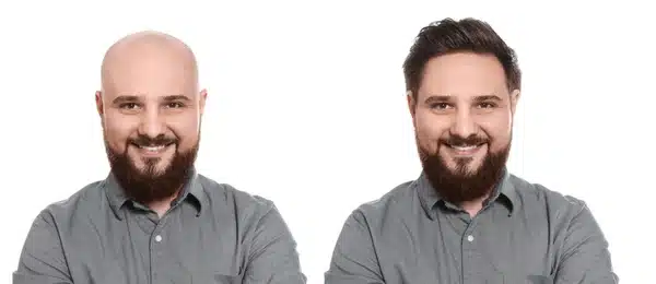 Ervas Naturais Contra Calvície