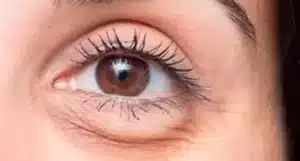 Elimine Bolsas nos Olhos Dormindo