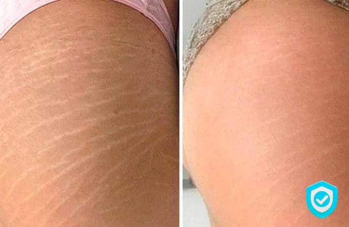 Pele Renovada: Adeus às Estrias